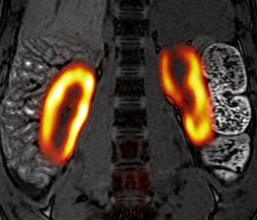 hyperpolarised-imaging