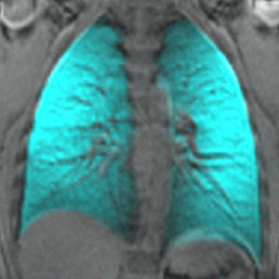 lungs—3He-image