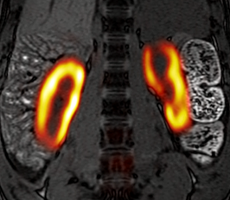 13C_Kidney_Aarhus