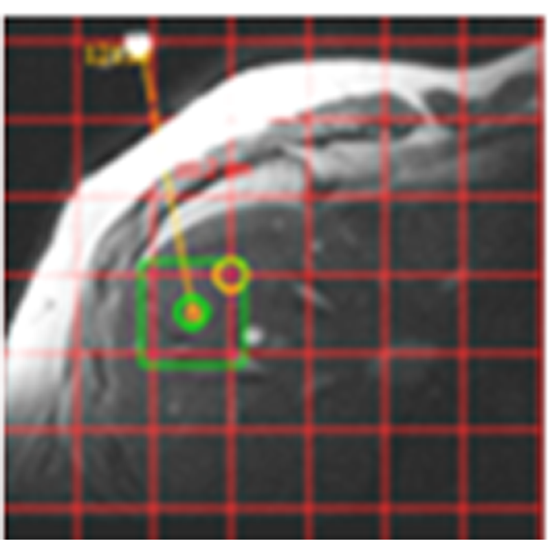 31P_dualtuned_liver_CSI