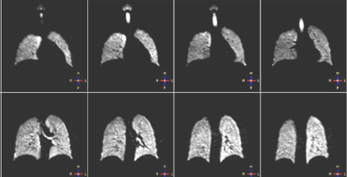 Hyperpolarised xenon lung imaging